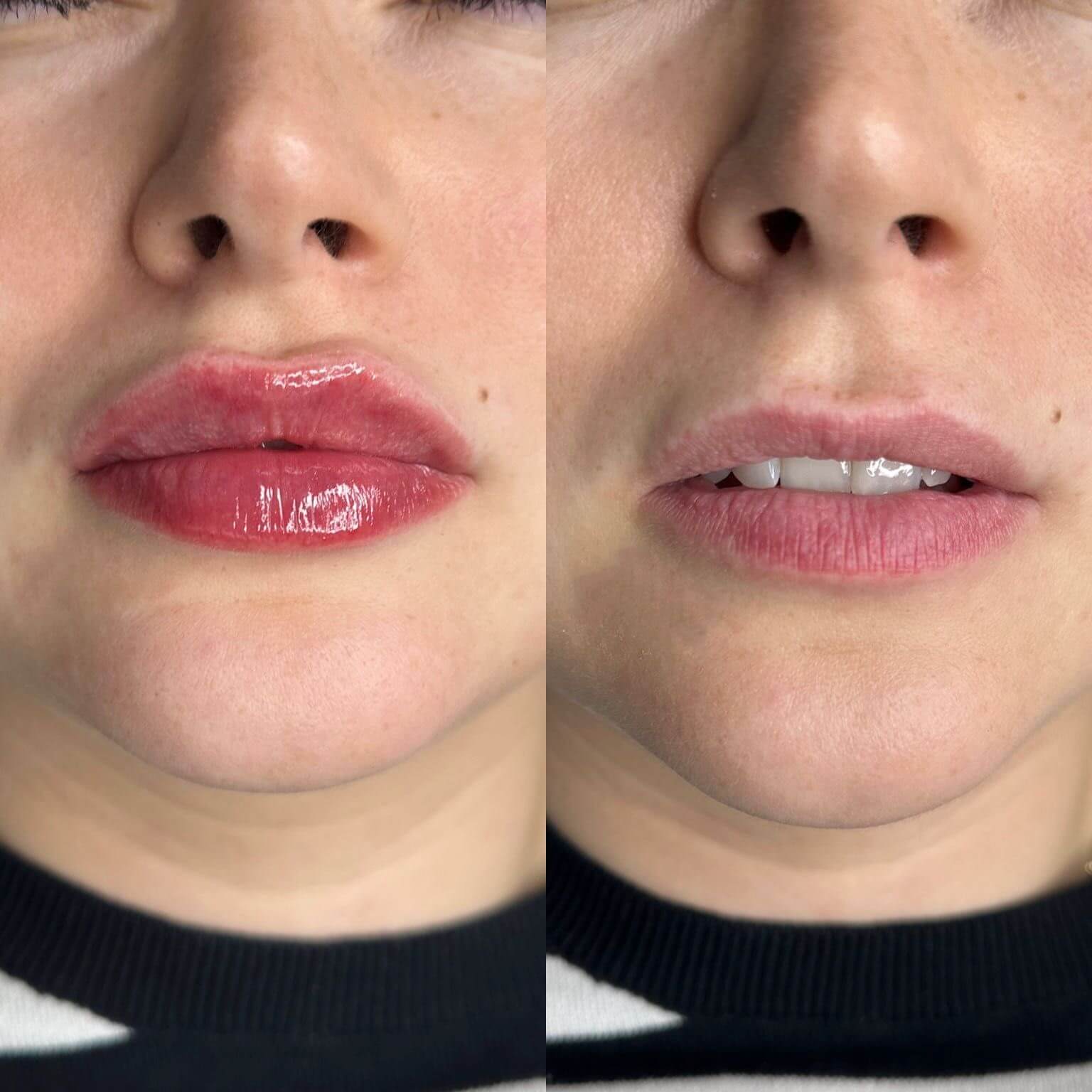 Modelowanie i powiększanie ust efekt - naturalne usta kwasem hialuronowym Głogów