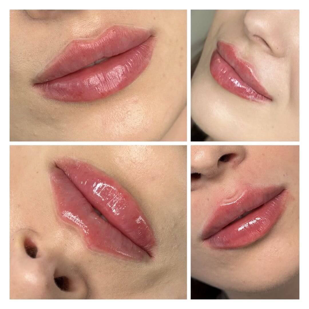 Efekty powiększania ust kwasem hialuronowym Natural Lips - AK Beauty CLUB Głogów